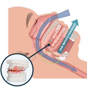 dental sleep apnea device